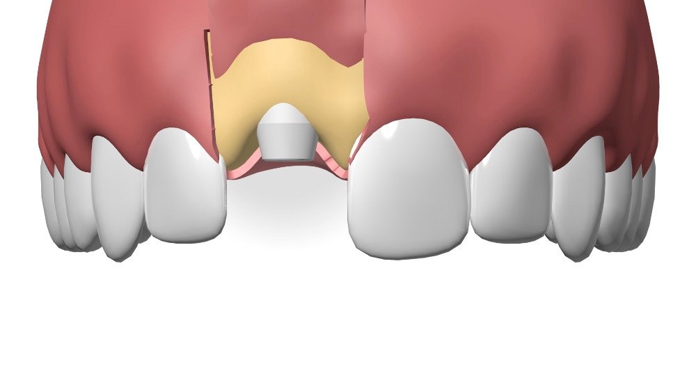 Implant dentaire Nimes